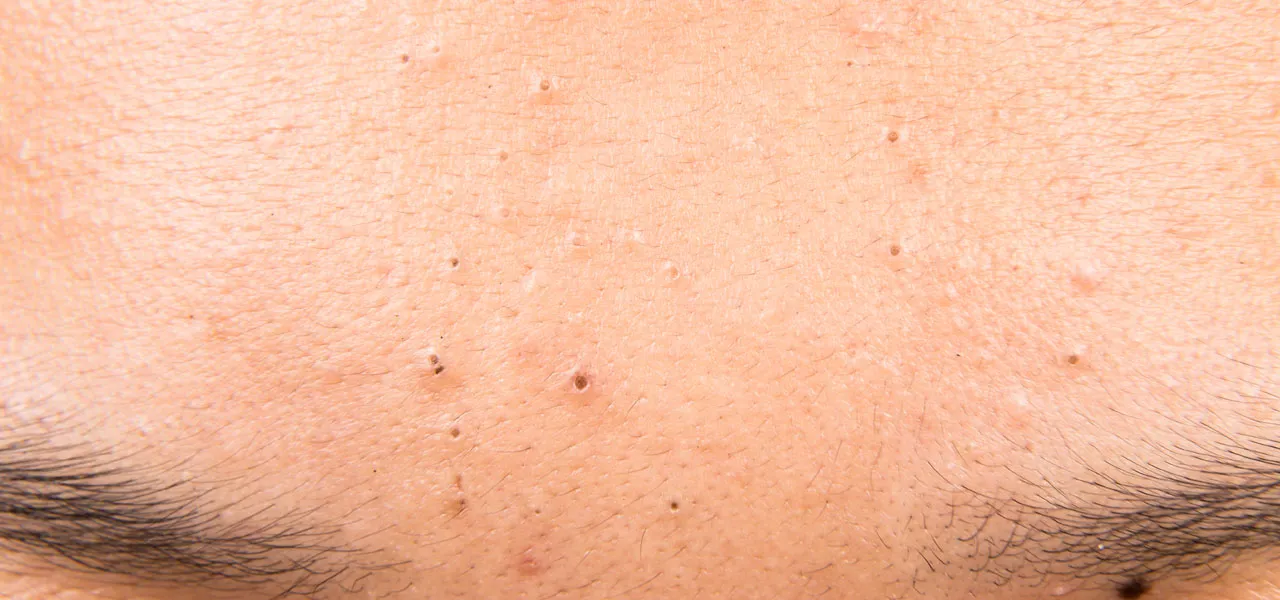 zapchana cera objawy zaskórniki otwarte zamknięte