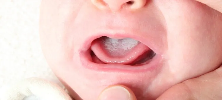 pleśniawki u niemowląt