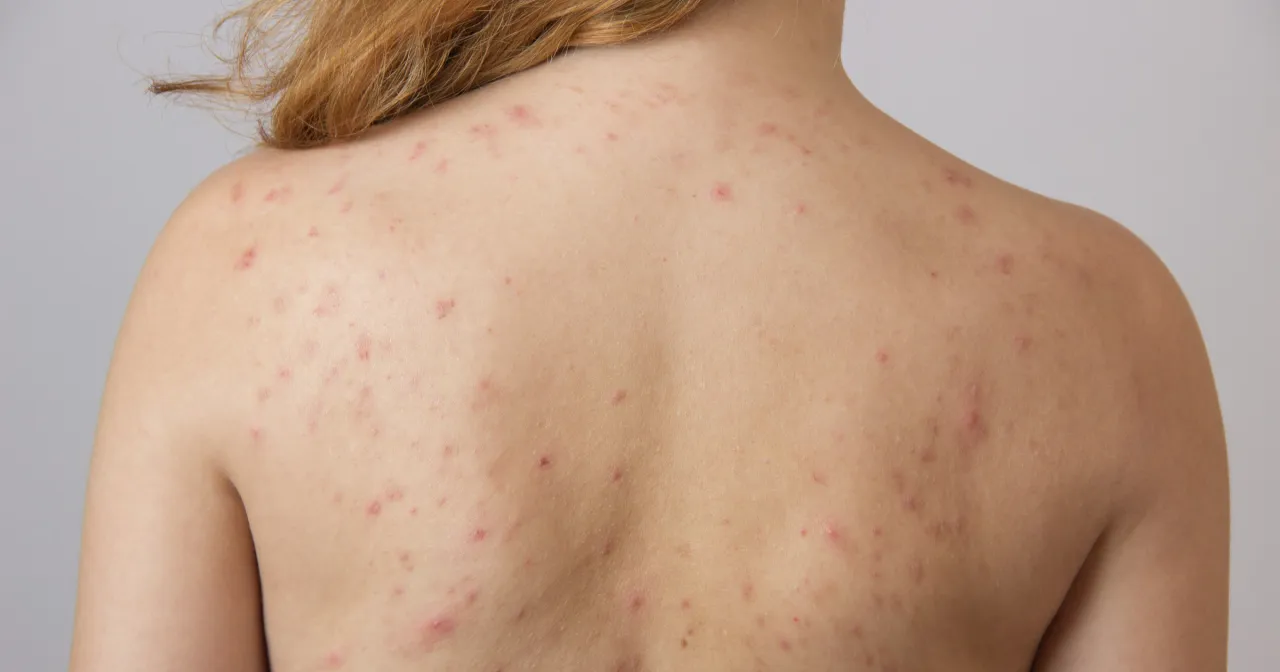 Dermatolog konsultacja trądzik plecy