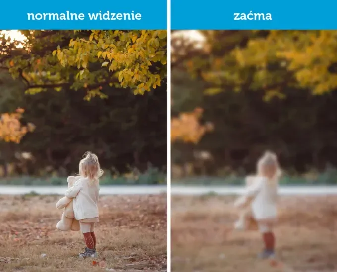 Symulacja widzenia z zaćmą - zamglony obraz