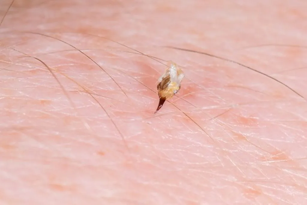 usuwanie żądła pszczoły