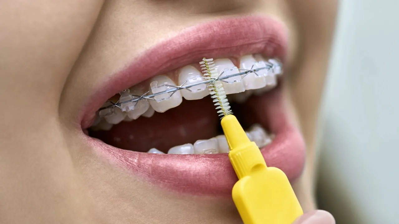 higiena zęb&oacute;w aparat ortodontyczny