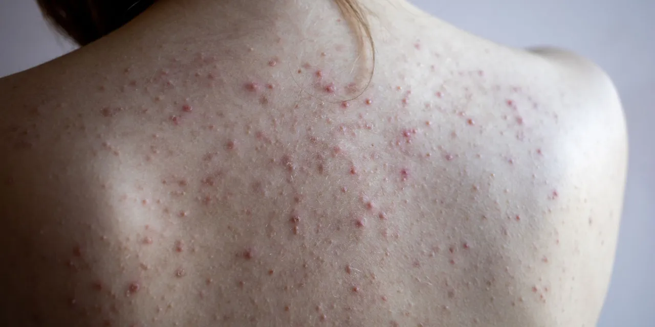 Dermatolog trądzik na plecach