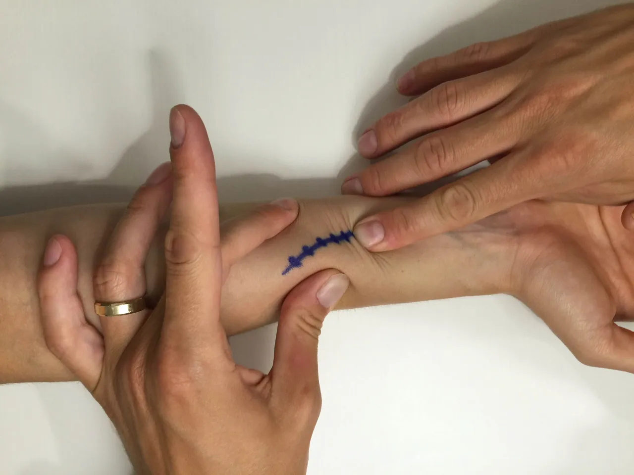 Mobilizacja blizny po operacji cieśni nadgarstka