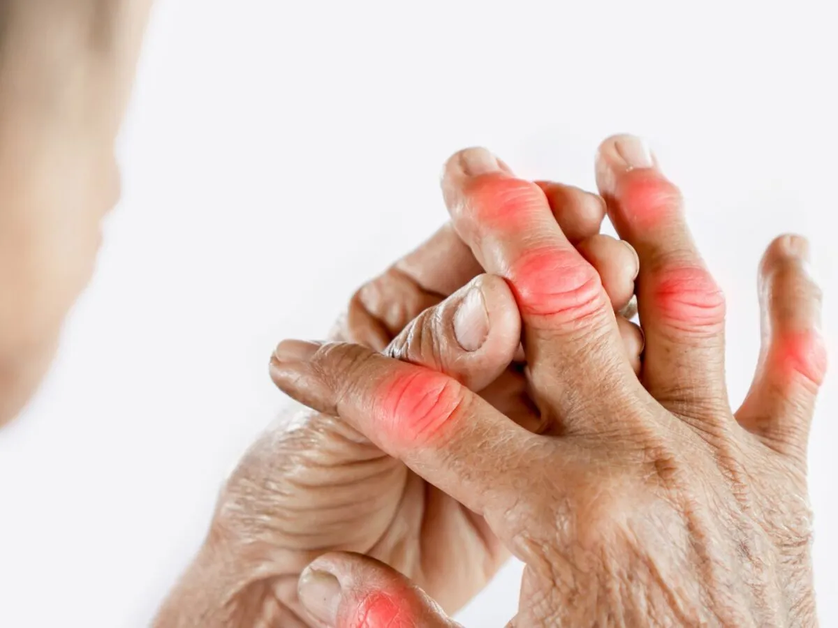 dna moczanowa objawy paluch