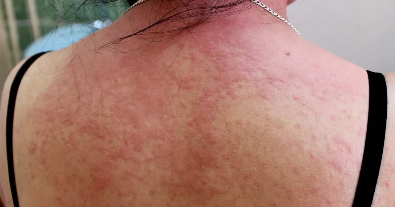 Objawy pozajelitowe IBS