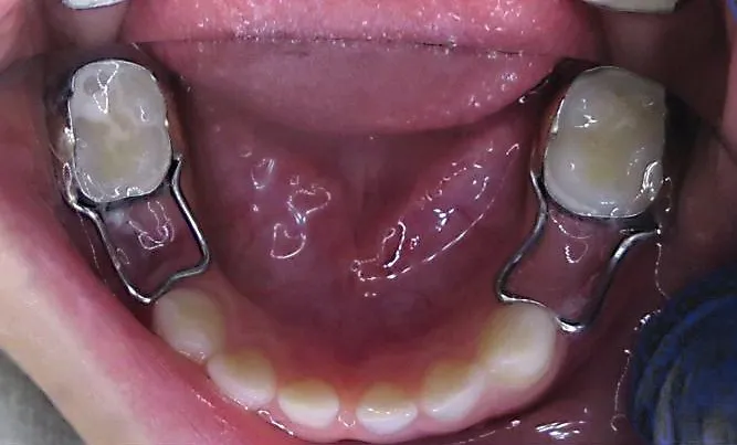 przesuwanie się zębów po usunięciu ósemki