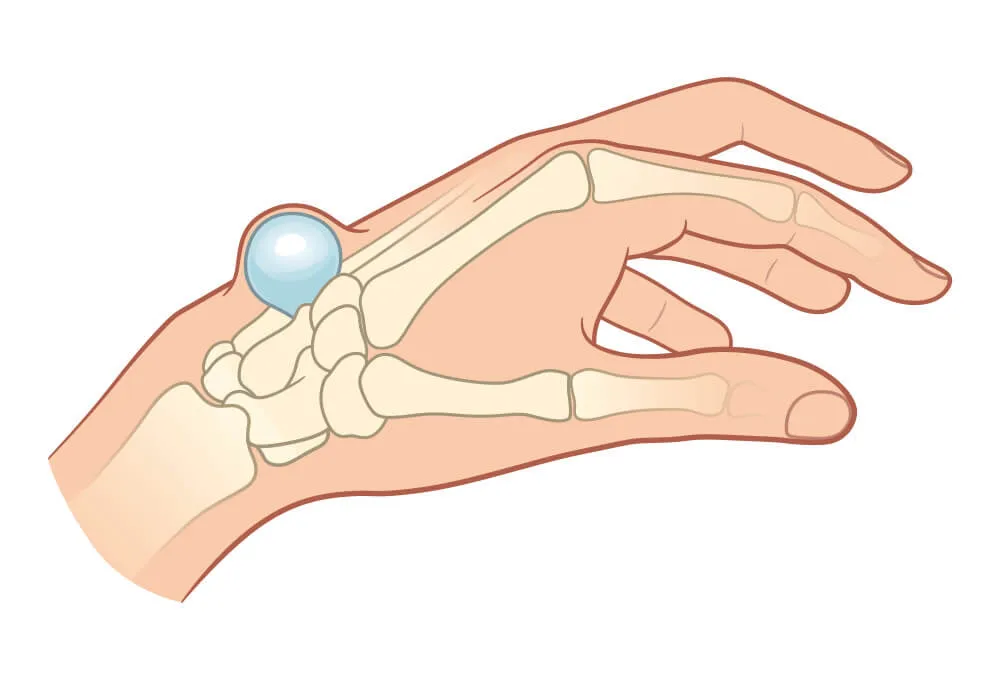 Zdjęcie Ganglion do jakiego lekarza? Odpowiedni specjalista na wagę zdrowia