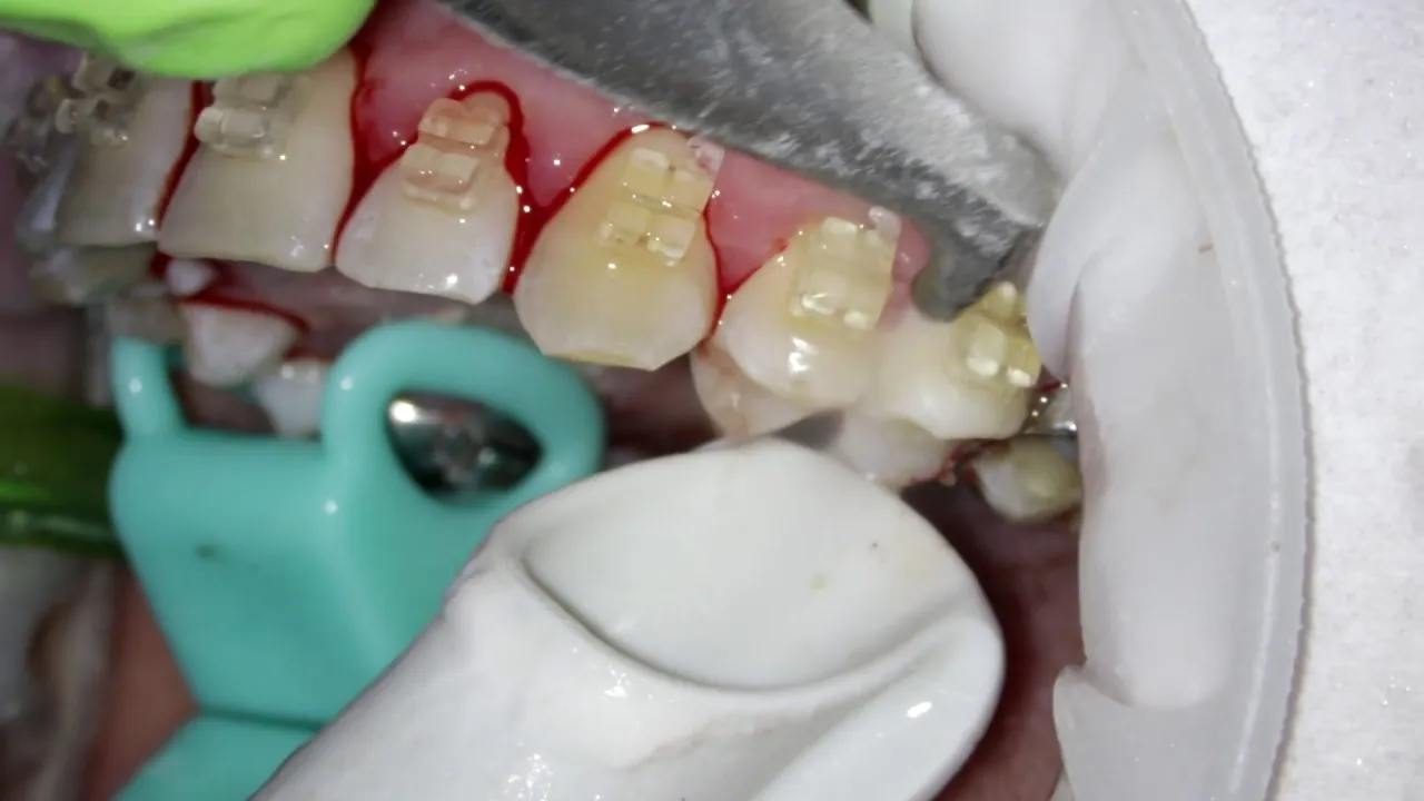 skaling piaskowanie zębów dentysta