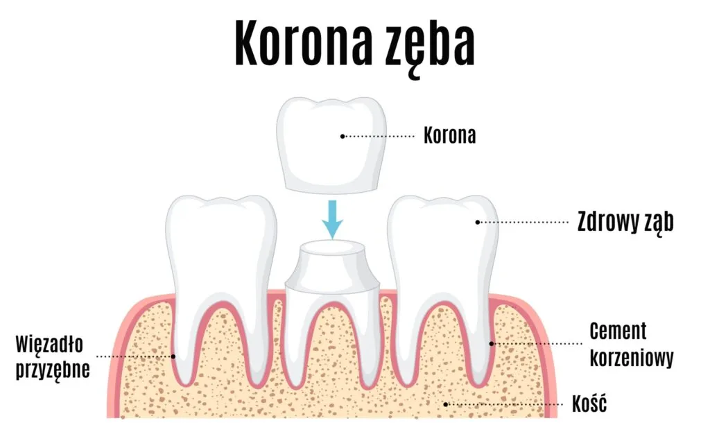 różne rodzaje koron zębowych porównanie