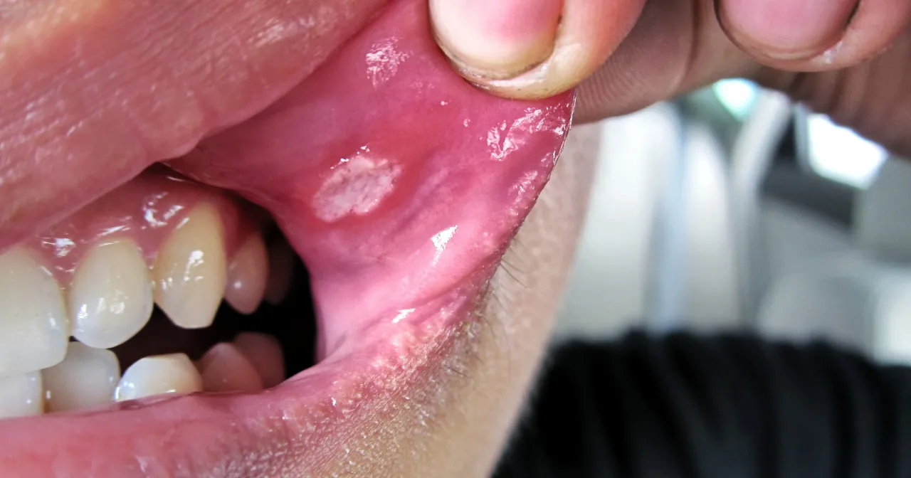 Afta na dziąśle wygląd, afty małe i duże porównanie