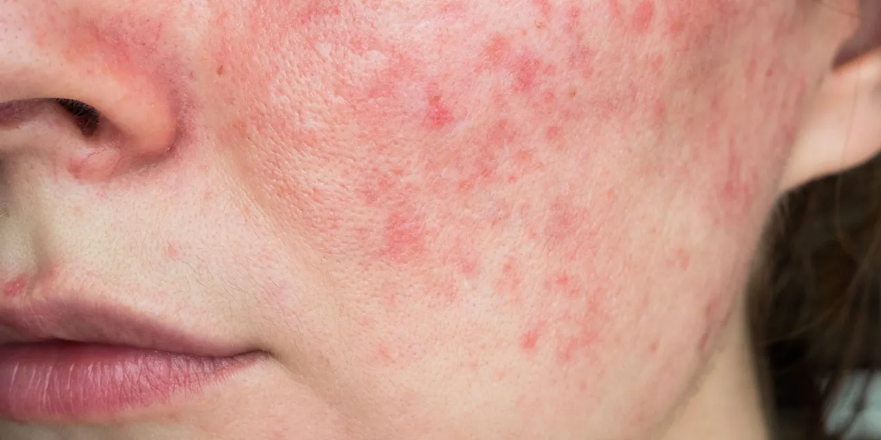 Trądzik różowaty objawy skóra