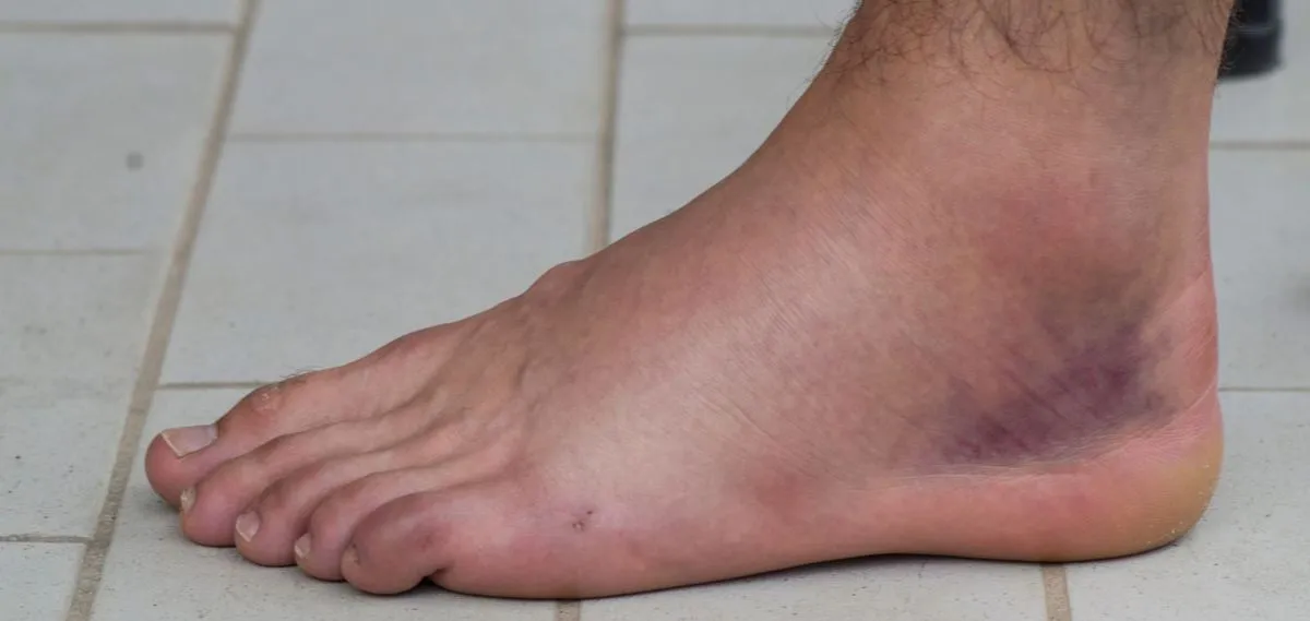 dokumentacja medyczna skręcenie stawu skokowego