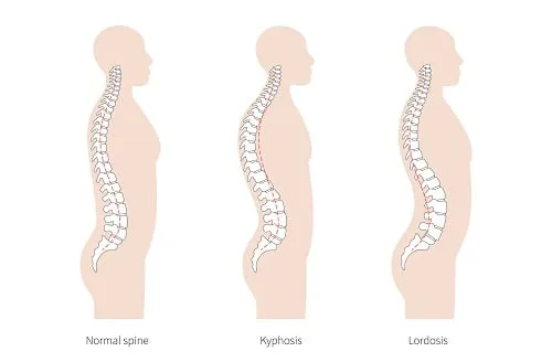lordoza lędźwiowa prawidłowa i pogłębiona porównanie