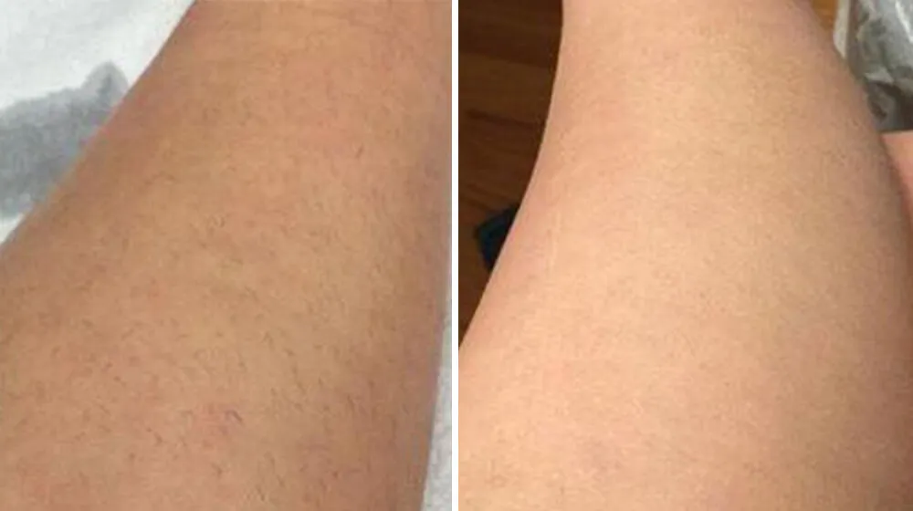 depilacja laserowa nóg przed i po
