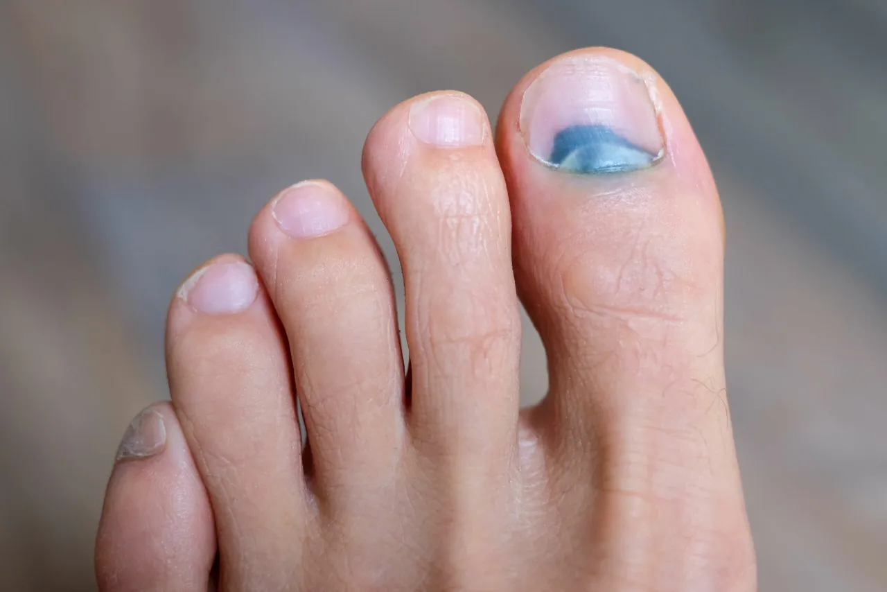 krwiak pod paznokciem etapy gojenia