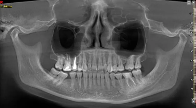 zdjęcie pantomograficzne zęba, tomografia zębów