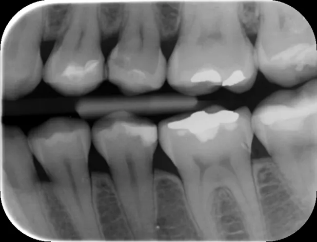 Pr&oacute;chnica na powierzchniach żujących i międzyzębowa RTG
