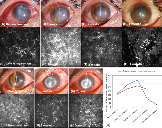 Acanthamoeba keratitis mikroskop
