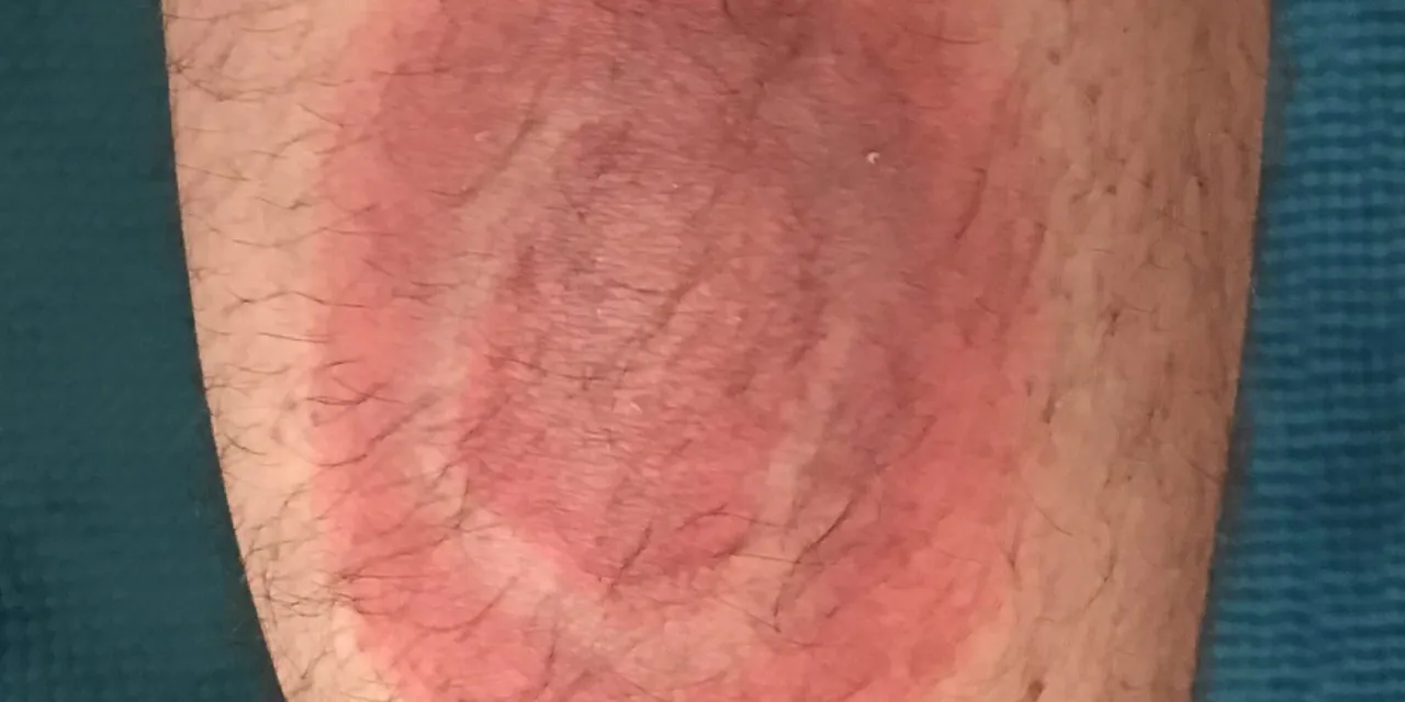 rumień wędrujący tarcza strzelnicza