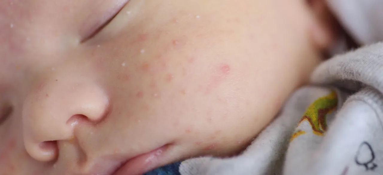 potówki u niemowlaka jak wyglądają