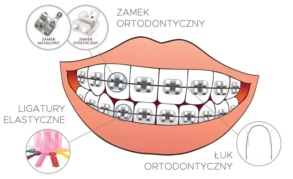 etapy leczenia ortodontycznego aparat stały