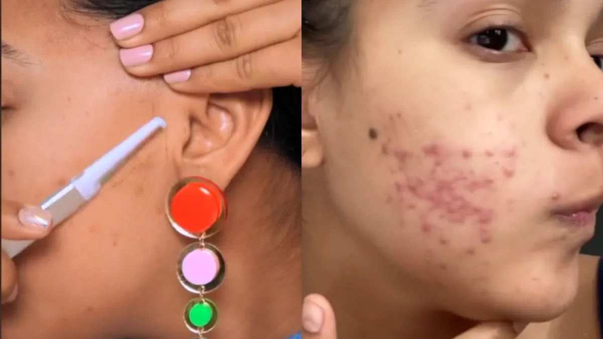 dermaplaning przed i po