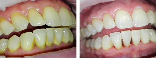 pełna higienizacja zębów przed i po