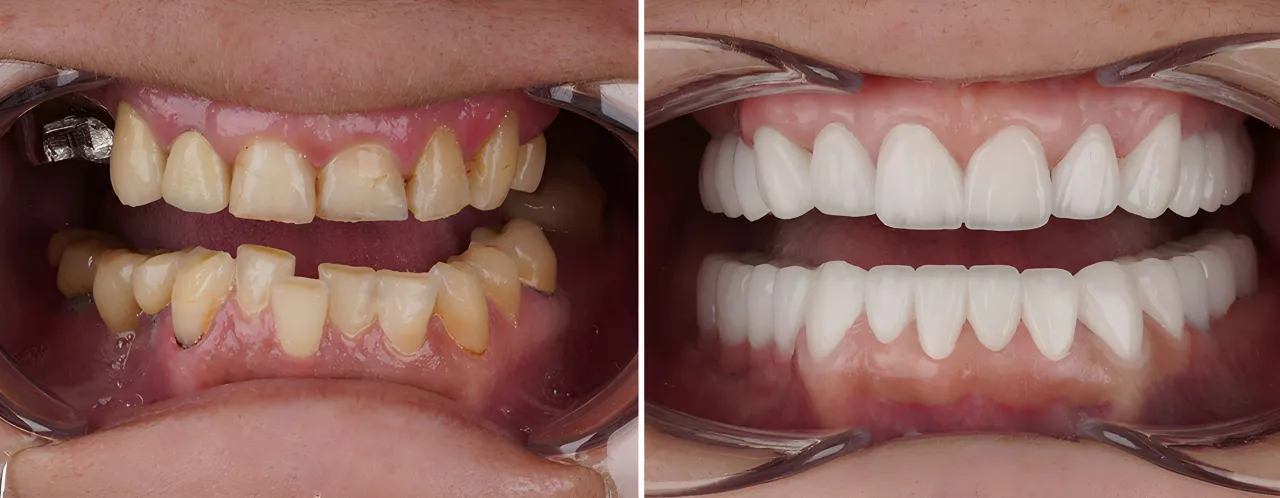 Zdjęcie Ile kosztuje przeszczep dziąsła? Ceny w Polsce i różnice w klinikach