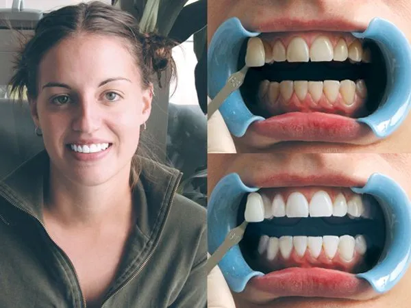 wybielanie zębów lampą beyond i nakładkami