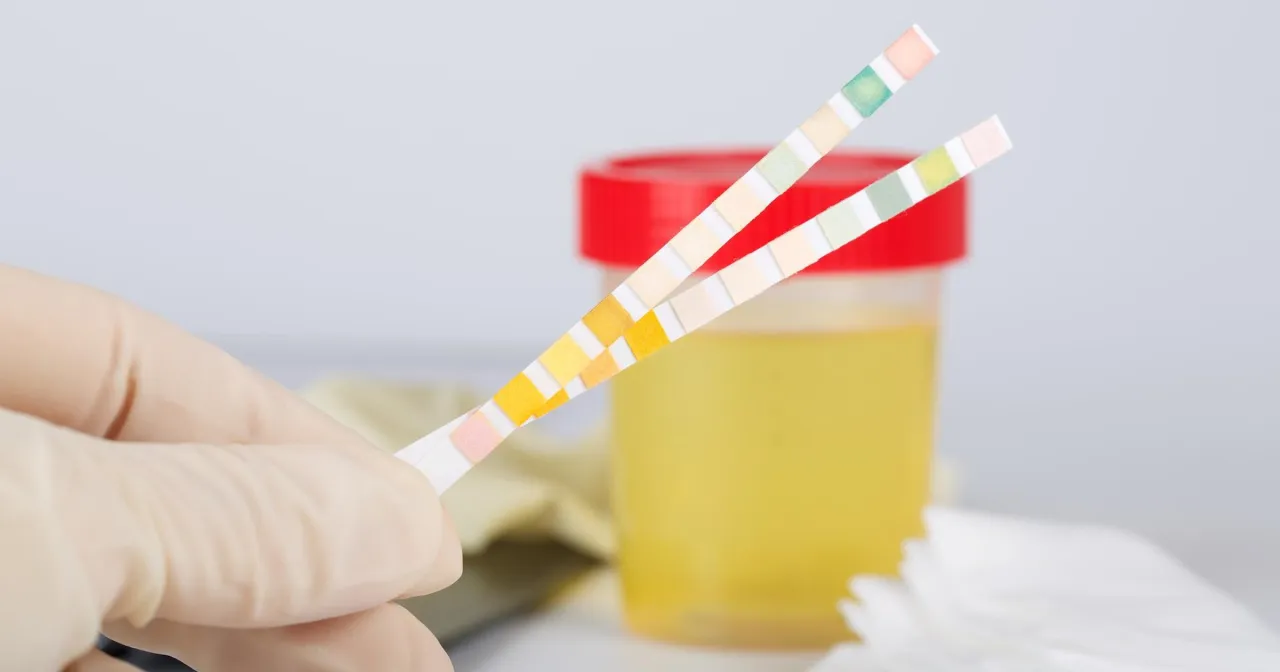 badanie krwi probówki dna moczanowa