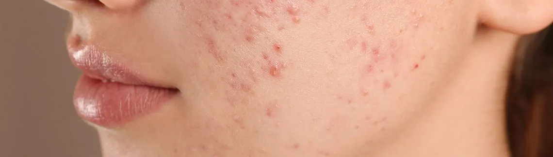 przygotowanie skóry pod makijaż pryszcza