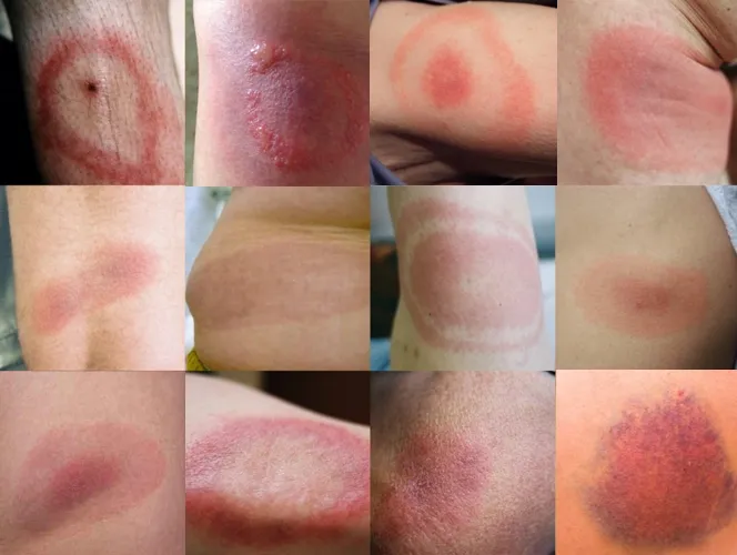 Rumień wędrujący po kleszczu, objawy boreliozy na sk&oacute;rze