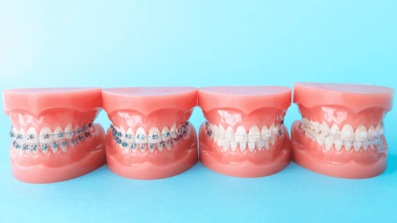 aparat ortodontyczny estetyczny na zębach