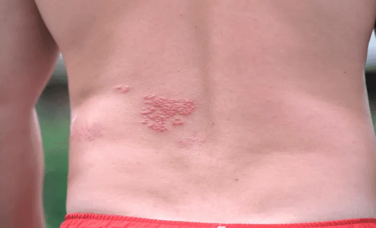 półpasiec wysypka początek