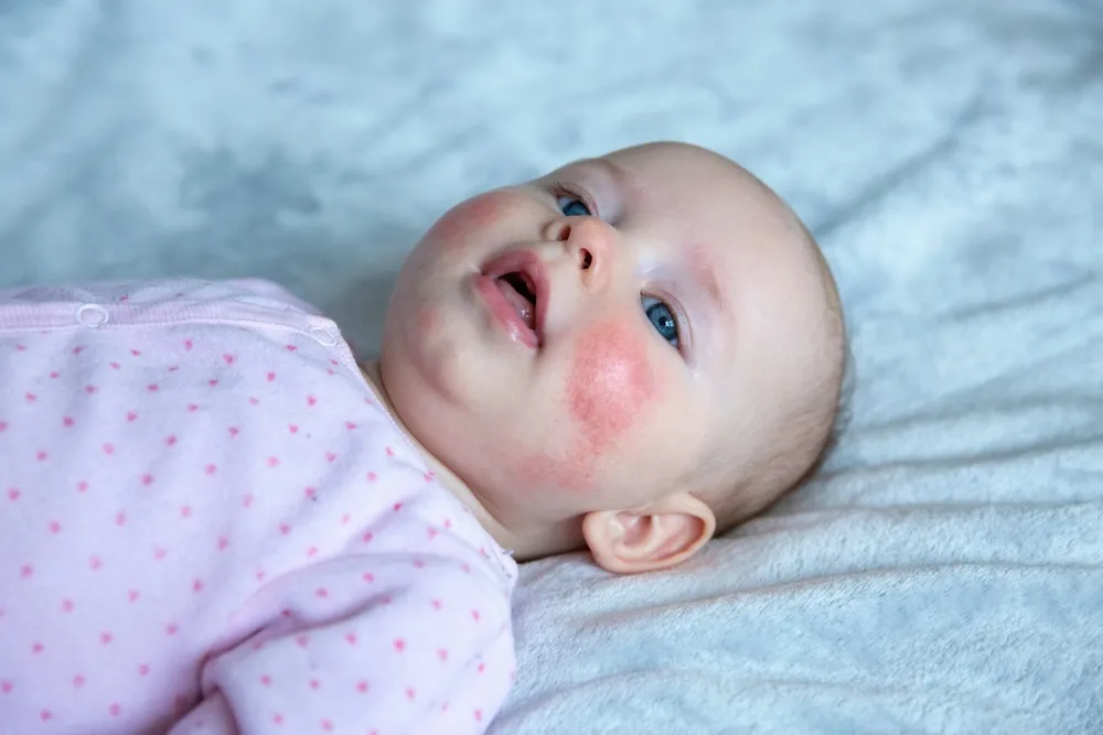 konsultacja lekarska niemowlę alergia