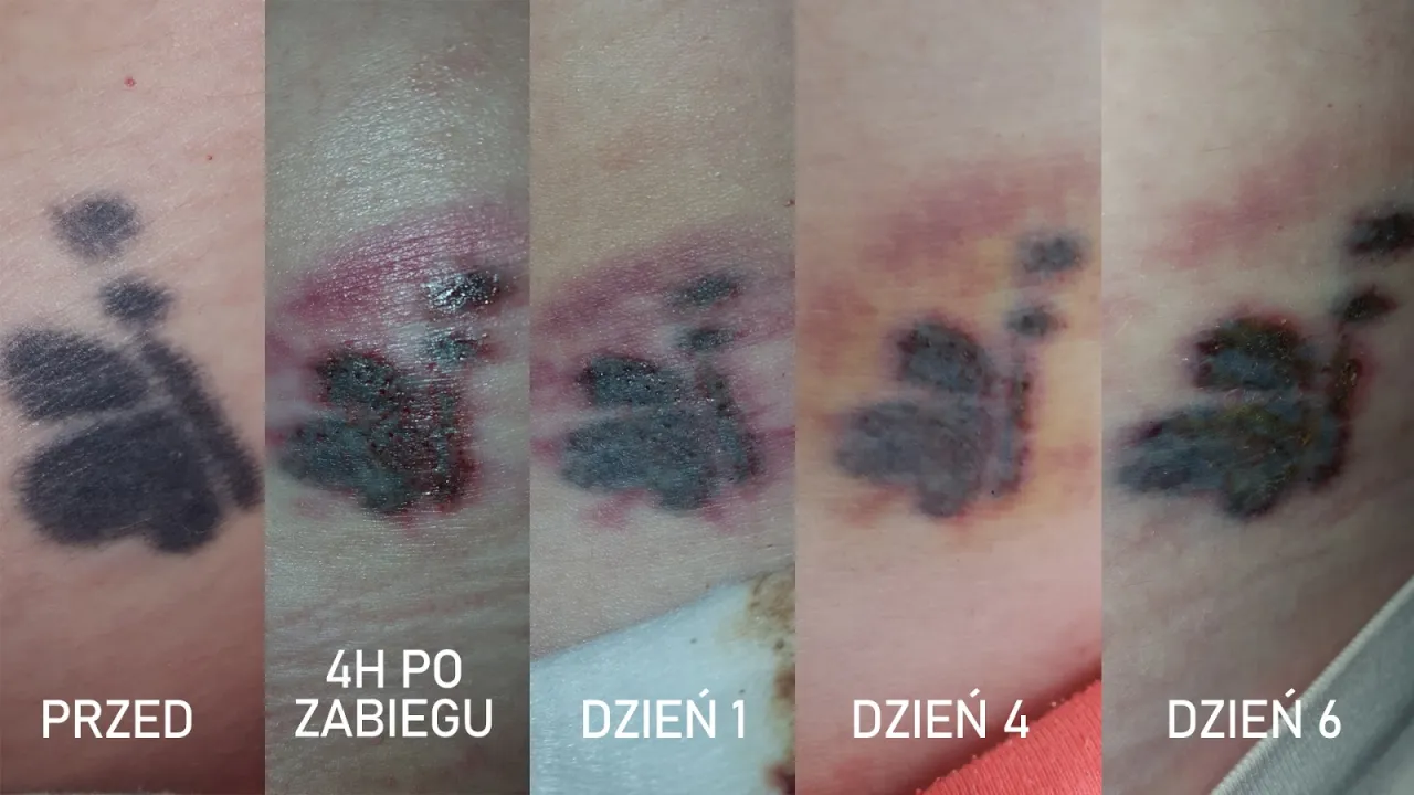 tatuaż gojenie etapy