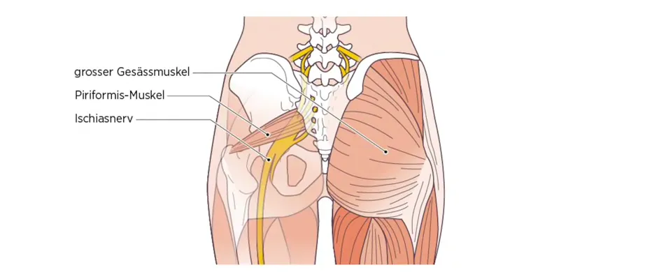 Anatomie eingeklemmter Nerv K&ouml;rperregionen