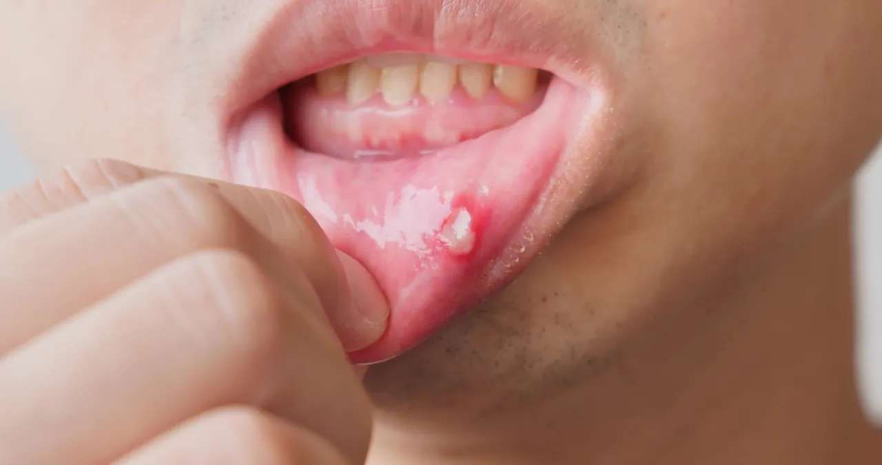Objawy zapalenia jamy ustnej: afty, zaczerwienienie, obrzęk