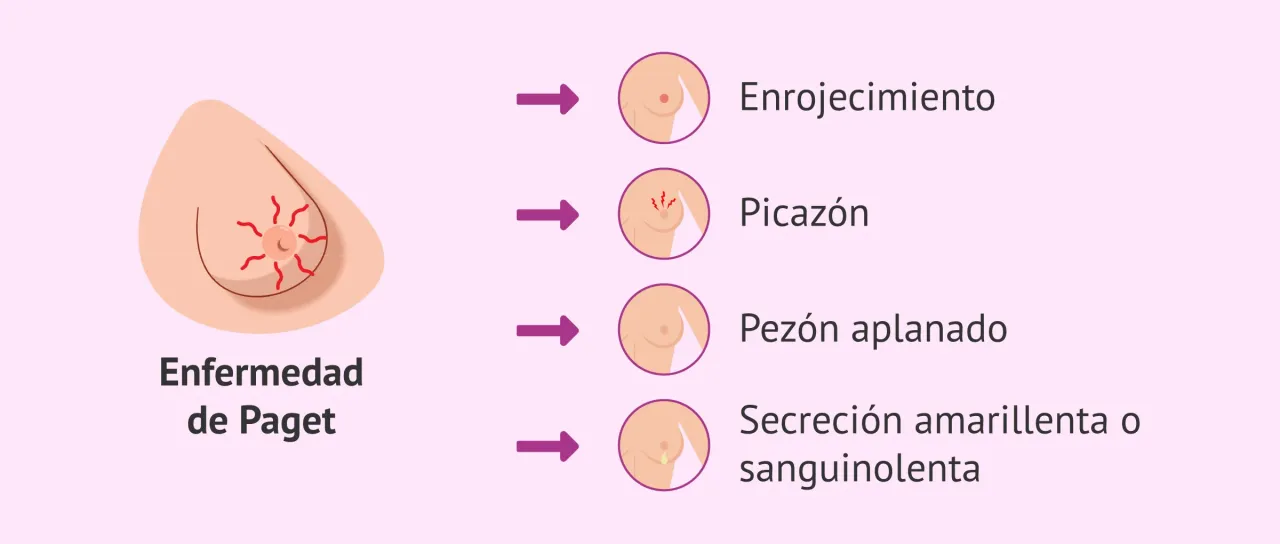 Zdjęcie S&iacute;ntomas c&aacute;ncer de mama: &iquest;Qu&eacute; se&ntilde;ales no debes ignorar?