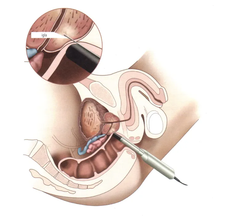 Zdjęcie Biopsja prostaty: Co musisz wiedzieć? Przebieg, przygotowanie, wyniki