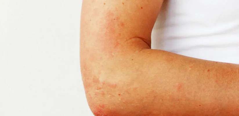 Zdjęcie Alergia na słońce objawy: Jak rozpoznać i uniknąć nieprzyjemności