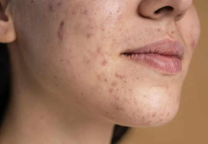 skóra trądzikowa podrażniona peelingiem mechanicznym