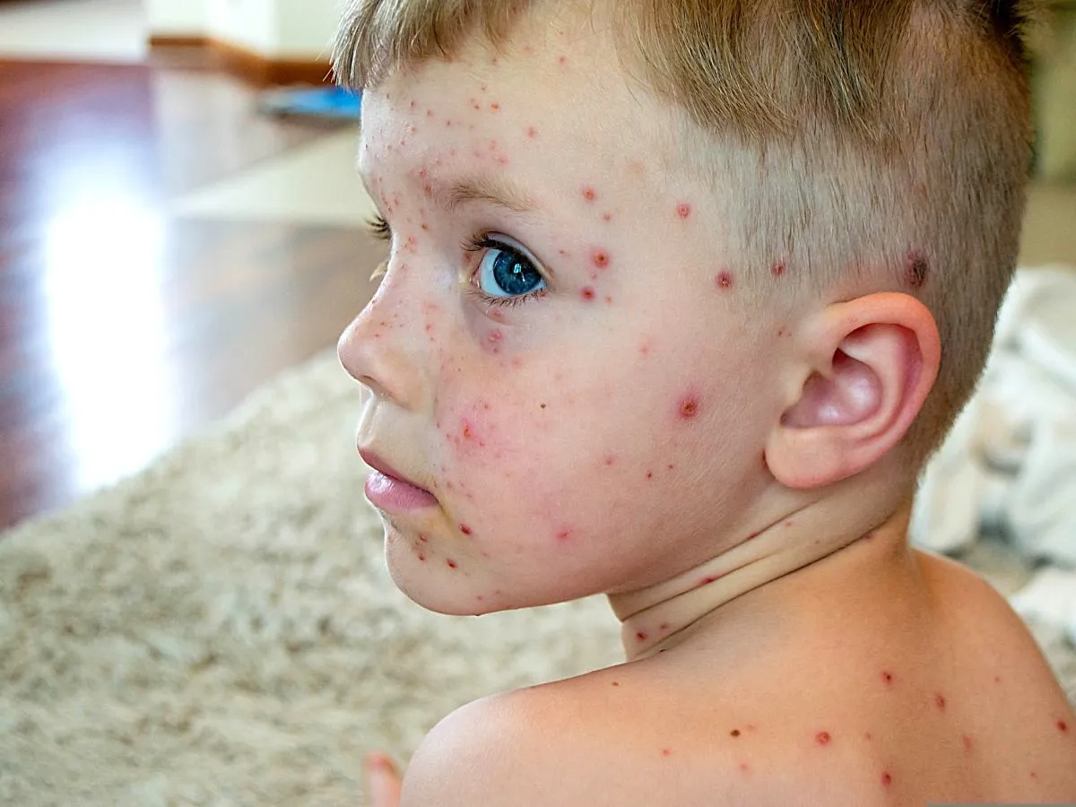 Dziecko po chorobie z ospą wietrzną uśmiechnięte