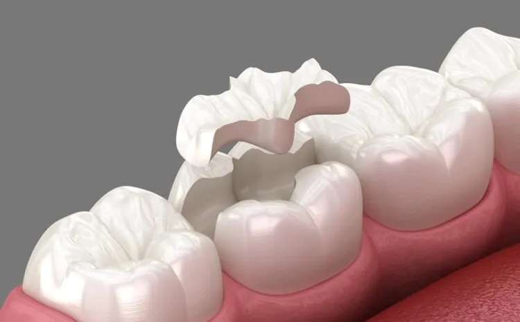 metody odbudowy zęba bonding licówki korony