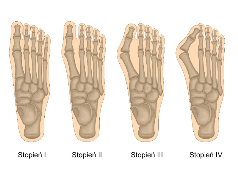 Anatomia stopy haluks deformacja