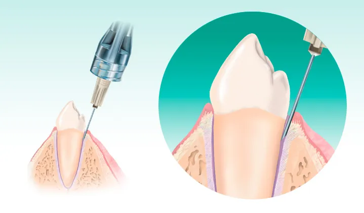 Znieczulenie komputerowe The Wand