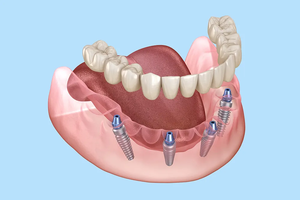 implanty zębowe mosty protetyczne