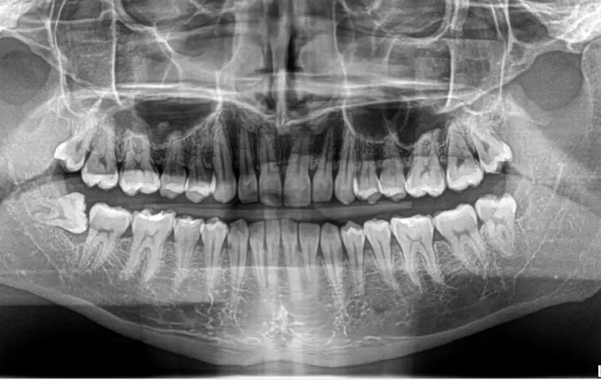 Zdjęcie RTG zdrowego zęba z opisem struktur