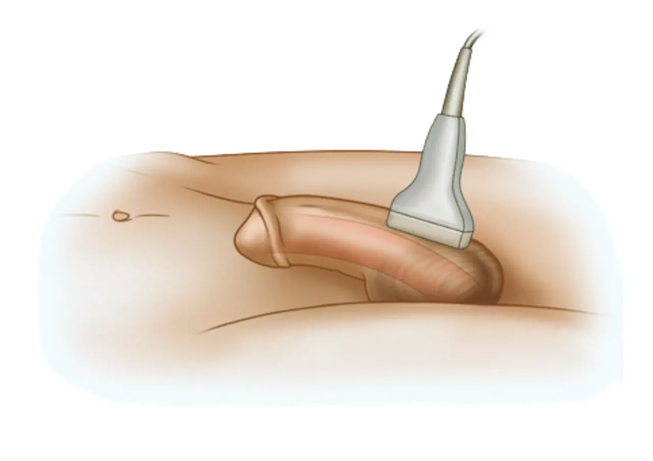 USG Doppler prącia test farmakologiczny
